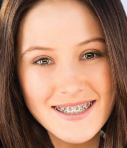 Carriere Motion Appliance - MyOrthodontist