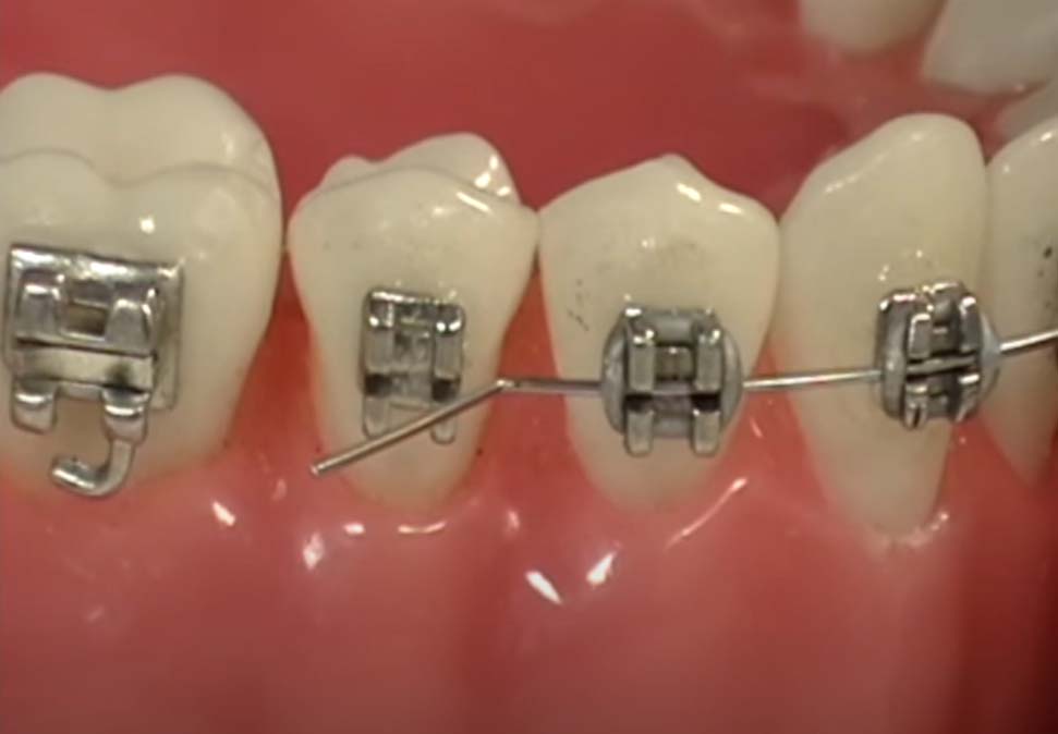 Poking Wire? Here are Some Pointers - Orthodontist Newark Middletown DE  Invisalign Braces Honig Orthodontics